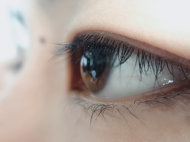 上眼皮為什么會(huì)下垂？上瞼下垂是怎么引起的？